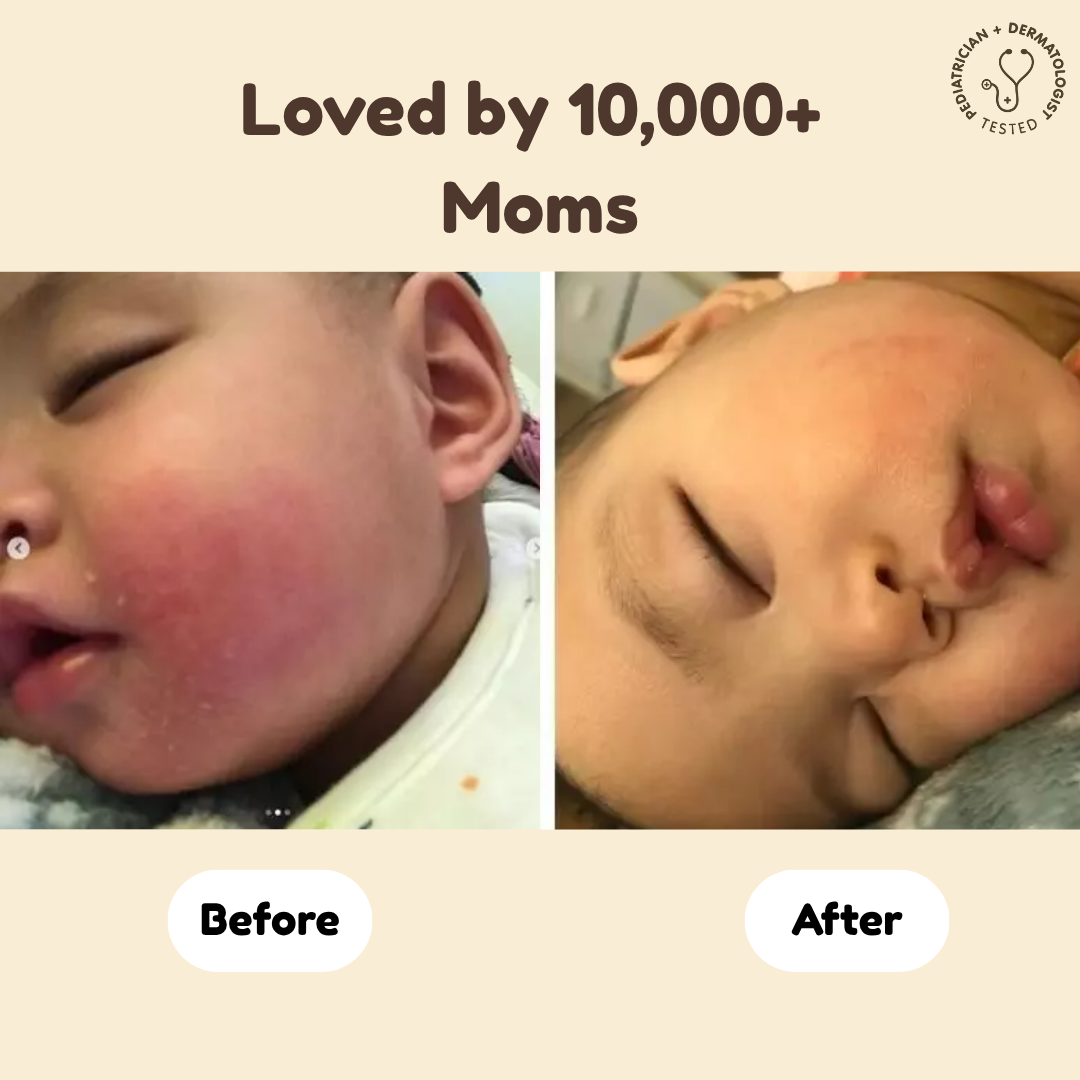 Beef Tallow Baby Balm Eczema Treatment
