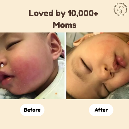 Beef Tallow Baby Balm Eczema Treatment